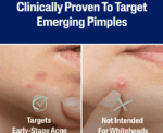 Pimple Clear Acne Spot Patches 24 Count - Image 