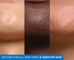 CeraVe Blemish Barrier Patches - Image 