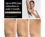 Braun Smart IPL Hair Removal Device - Image 